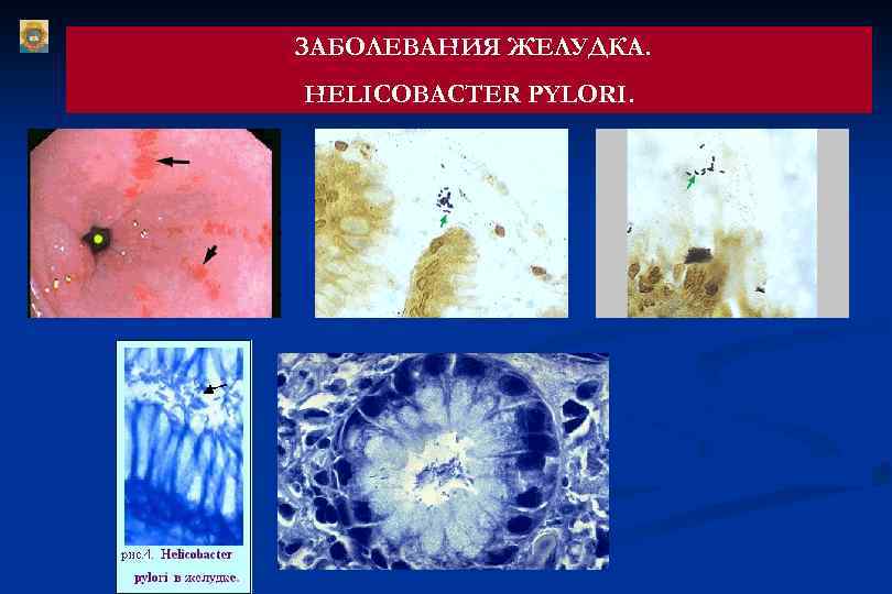 ЗАБОЛЕВАНИЯ ЖЕЛУДКА. HELICOBACTER PYLORI. 