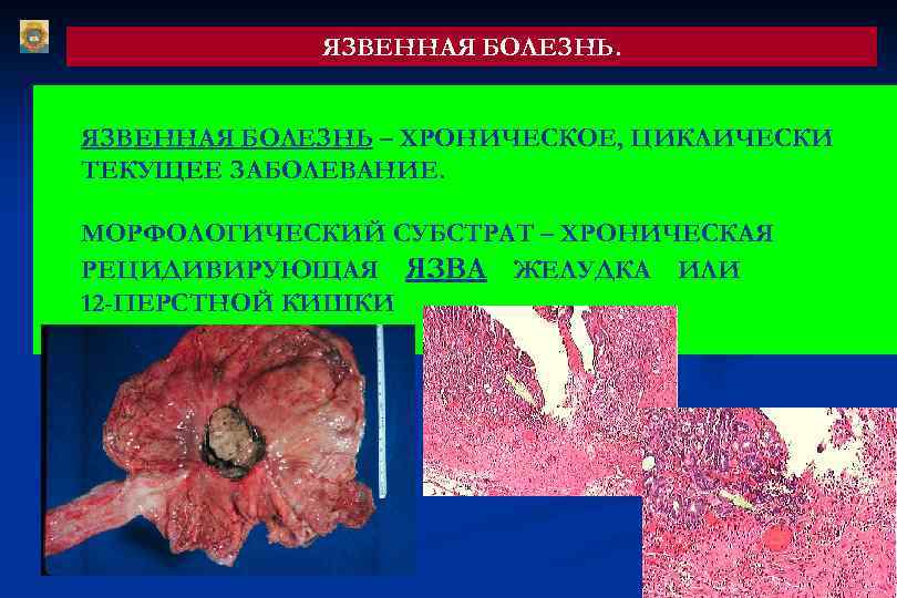 ЯЗВЕННАЯ БОЛЕЗНЬ – ХРОНИЧЕСКОЕ, ЦИКЛИЧЕСКИ ТЕКУЩЕЕ ЗАБОЛЕВАНИЕ. МОРФОЛОГИЧЕСКИЙ СУБСТРАТ – ХРОНИЧЕСКАЯ РЕЦИДИВИРУЮЩАЯ ЯЗВА ЖЕЛУДКА