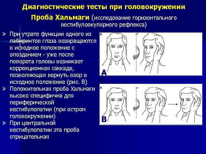 Диагностические тесты при головокружении Проба Хальмаги (исследование горизонтального вестибулоокулярного рефлекса) Ø При утрате функции