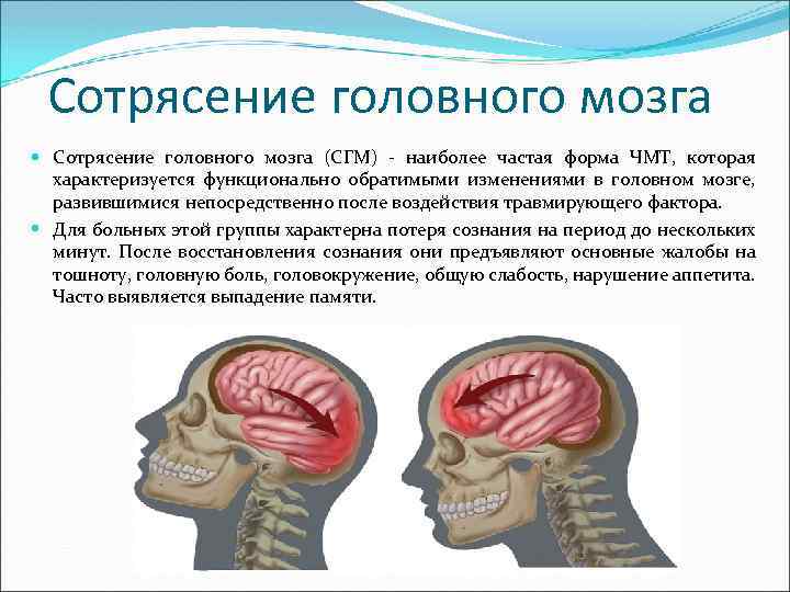 Сотрясение головного мозга (СГМ) - наиболее частая форма ЧМТ, которая характеризуется функционально обратимыми изменениями