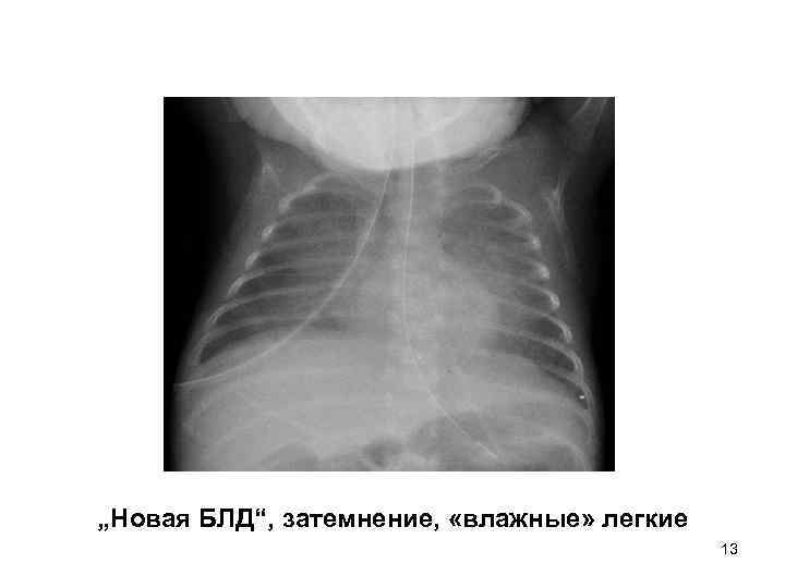 „Новая БЛД“, затемнение, «влажные» легкие 13 