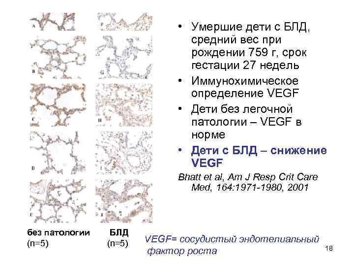  • Умершие дети с БЛД, средний вес при рождении 759 г, срок гестации