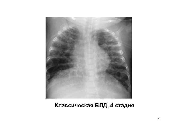 Классическая БЛД, 4 стадия 4 