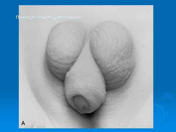 Пеноскротальная транспозиция 