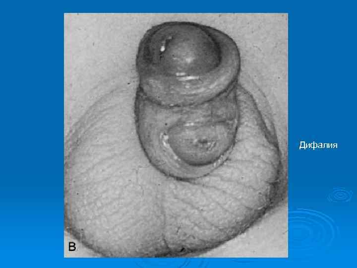Дифалия 