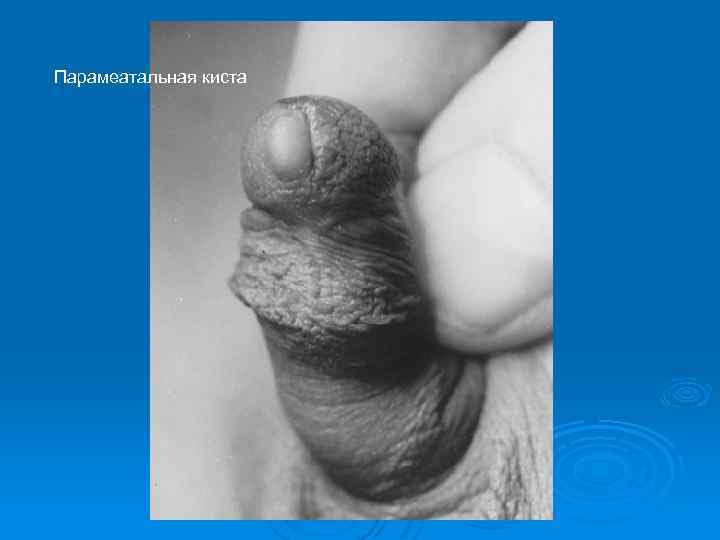 Парамеатальная киста 