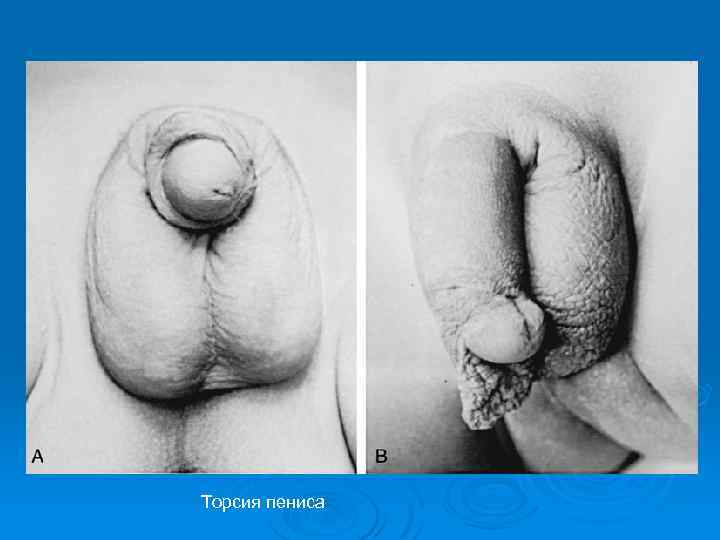 Торсия пениса 