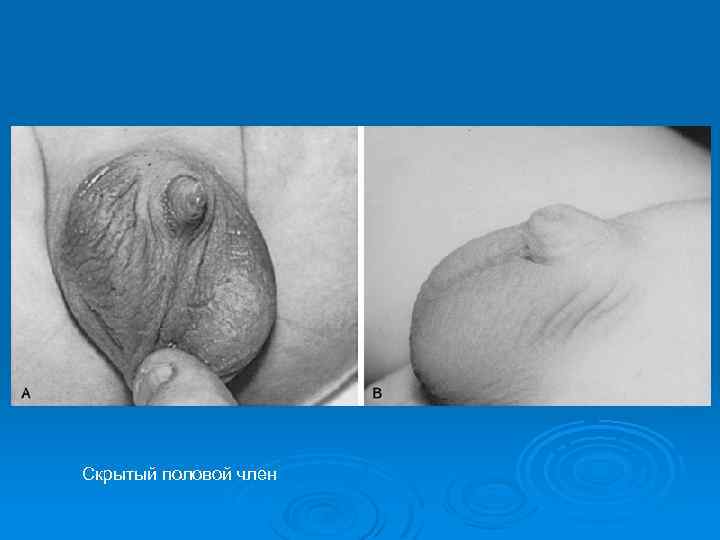Скрытый половой член 