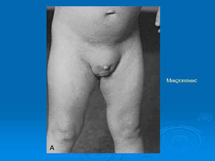Микропенис 