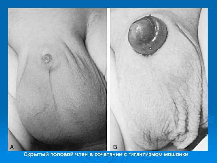 Скрытый половой член в сочетании с гигантизмом мошонки 