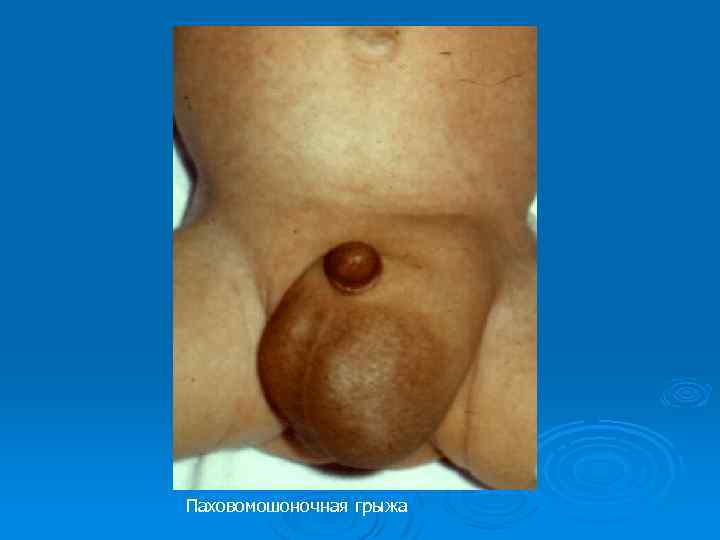 Паховомошоночная грыжа 