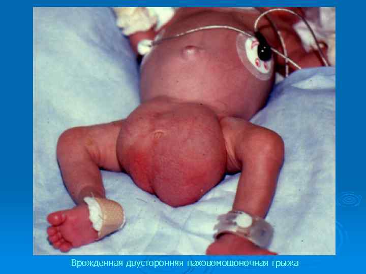 Врожденная двусторонняя паховомошоночная грыжа 