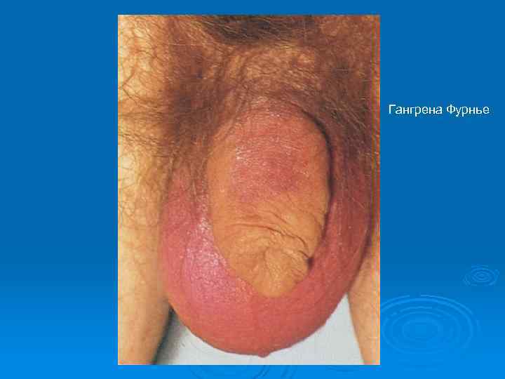 Гангрена Фурнье 