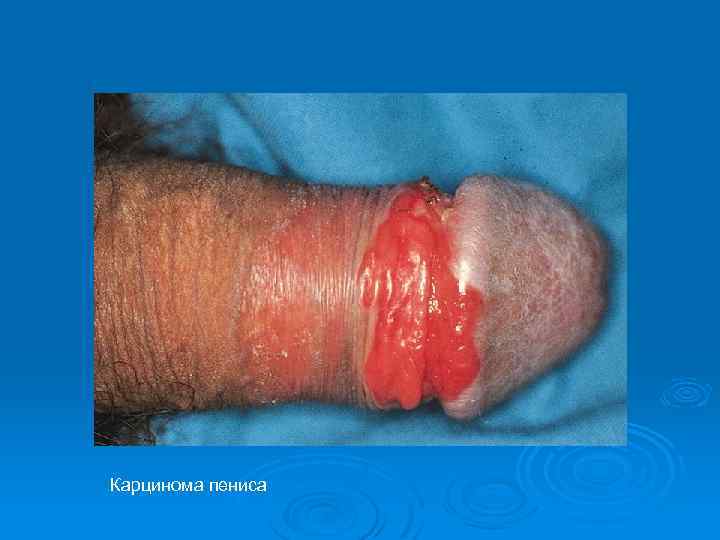 Карцинома пениса 