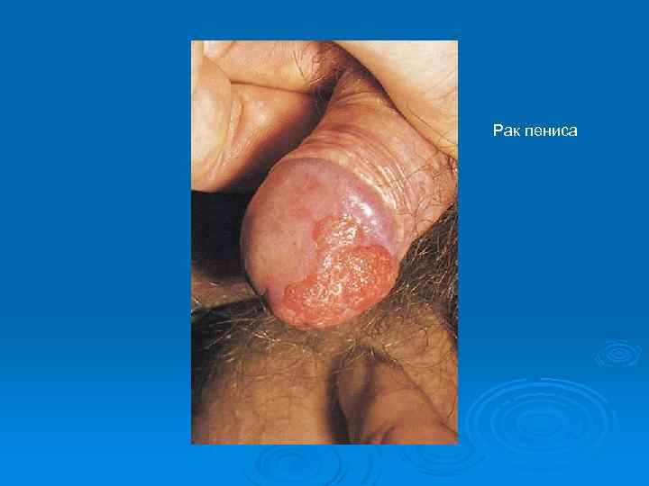 Рак пениса 