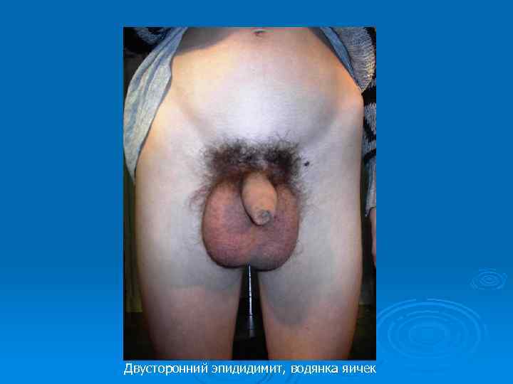 Двусторонний эпидидимит, водянка яичек 