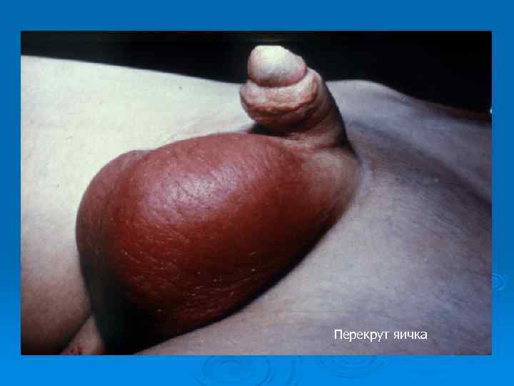 Перекрут яичка 