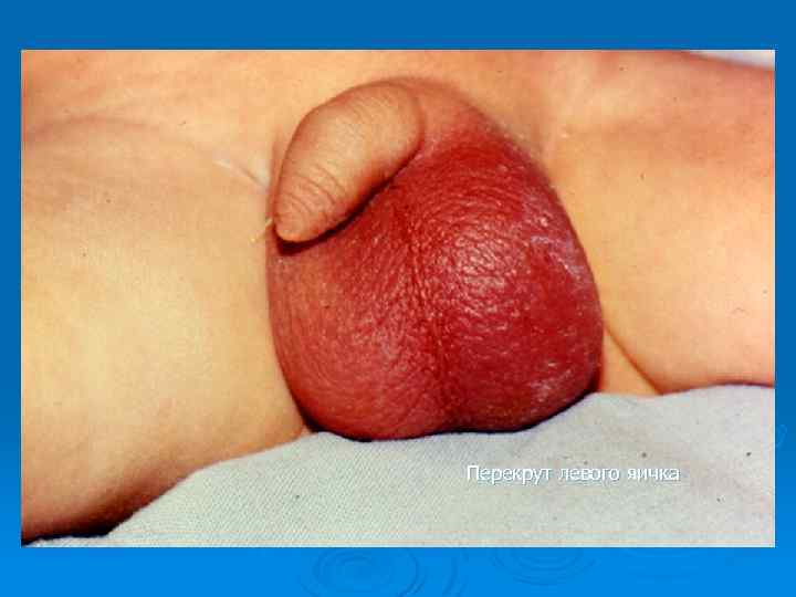Перекрут левого яичка 