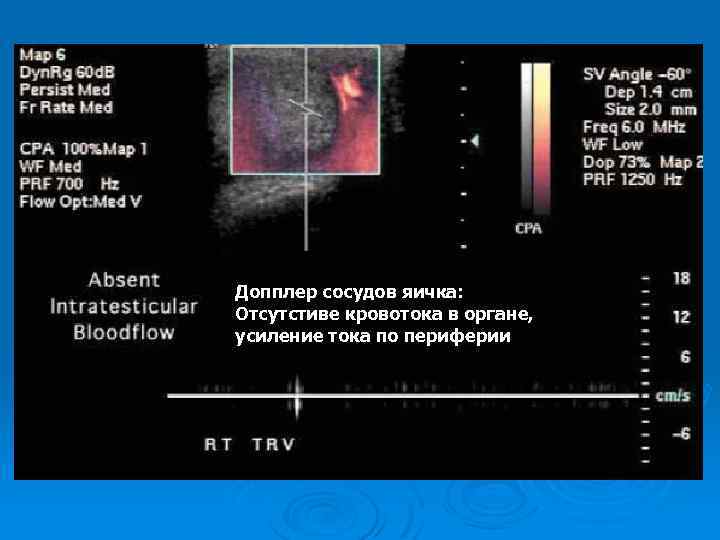 Допплер сосудов яичка: Отсутстиве кровотока в органе, усиление тока по периферии 