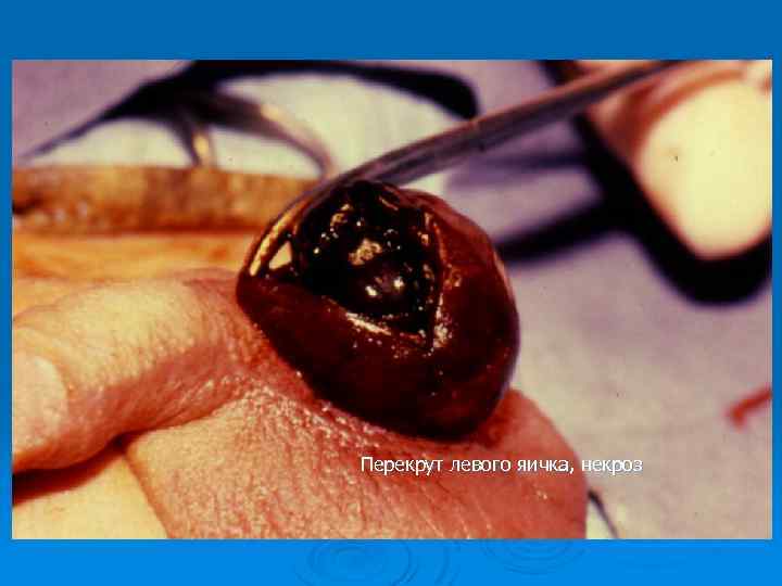 Перекрут левого яичка, некроз 