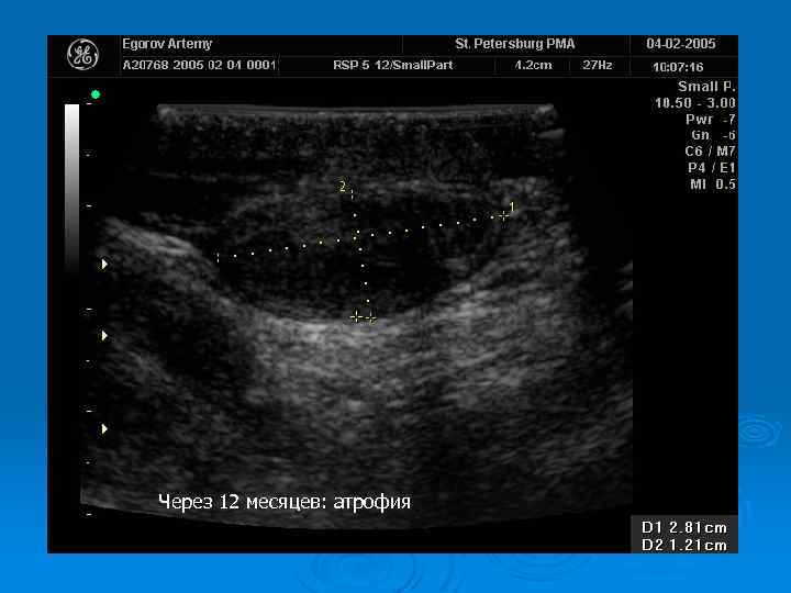 Через 12 месяцев: атрофия 