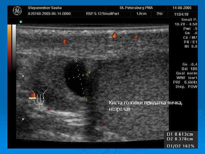 Киста головки у мужчин. Кичта голоаки придатка яич. Киста головки придатка яичка. Киста придатка яичка на УЗИ.