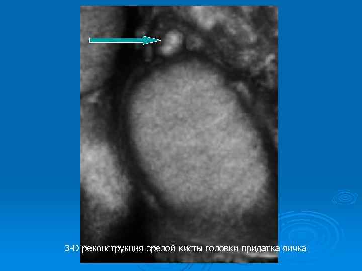 3 -D реконструкция зрелой кисты головки придатка яичка 