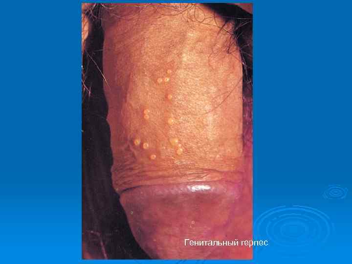 Генитальный герпес 