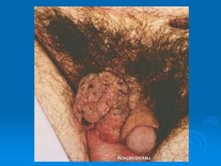 Кондилломы 