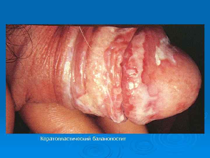 Кератопластический баланопостит 