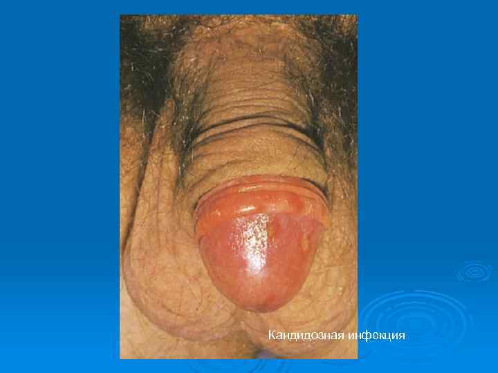 Кандидозная инфекция 