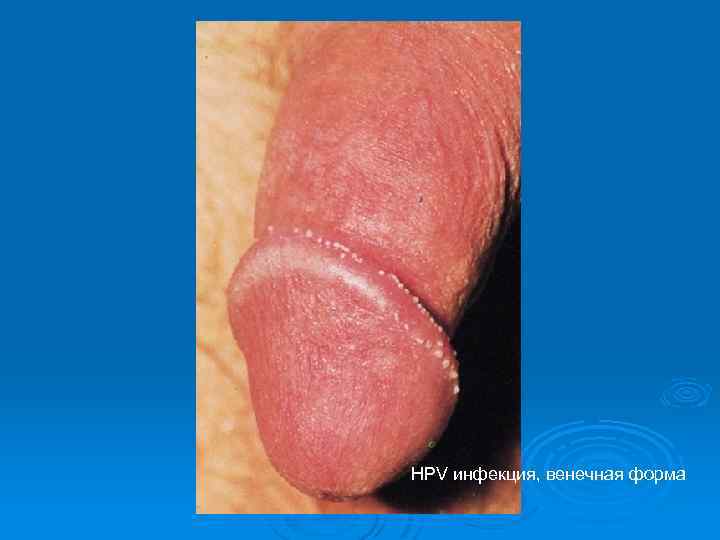 HPV инфекция, венечная форма 
