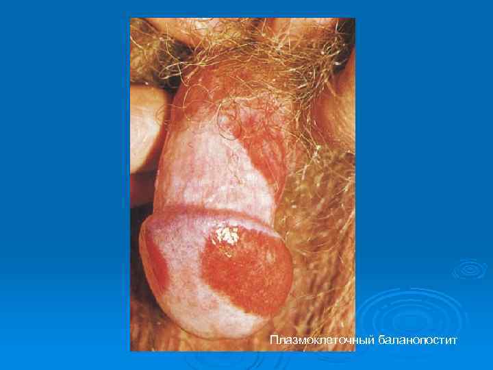 Плазмоклеточный баланопостит 