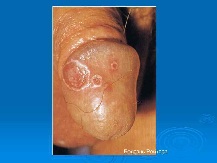 Болезнь Рейтера 