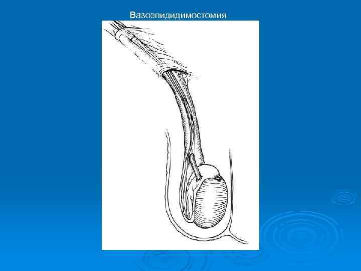 Вазоэпидидимостомия 