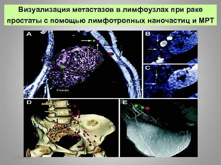 Визуализация метастазов в лимфоузлах при раке простаты с помощью лимфотропных наночастиц и МРТ 2/17/2018