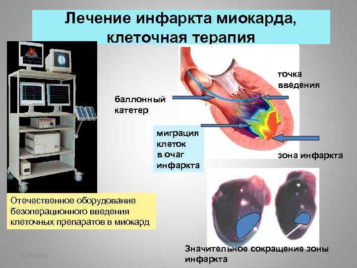 Лечение инфаркта миокарда, клеточная терапия точка введения баллонный катетер миграция клеток в очаг инфаркта