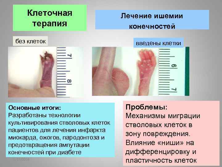 Клеточная терапия без клеток Основные итоги: Разработаны технологии культивирования стволовых клеток пациентов для лечения