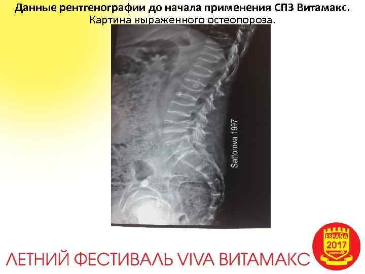 Данные рентгенографии до начала применения СПЗ Витамакс. Картина выраженного остеопороза. 