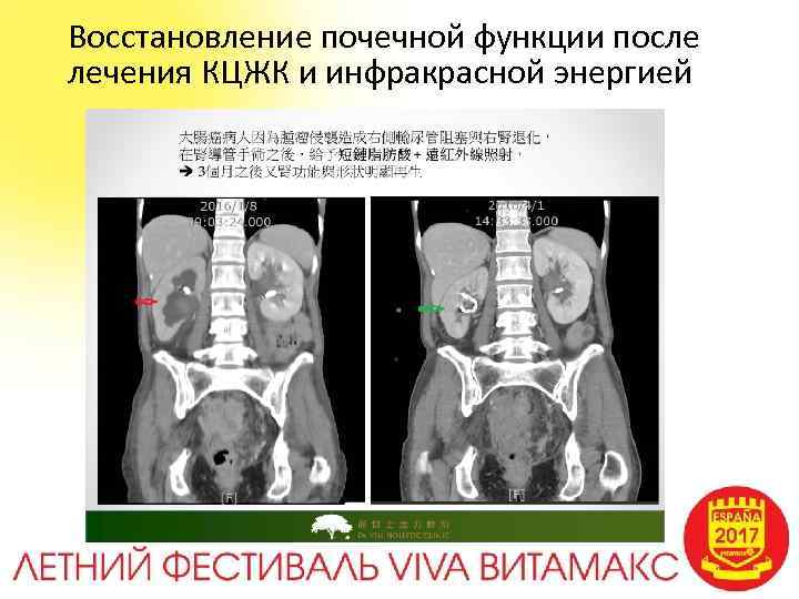 Восстановление почек. Регенерация функции почек. Восстановление функции почек. Самовосстановление почек.