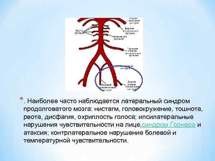 *. Наиболее часто наблюдается латеральный синдром продолговатого мозга: нистагм, головокружение, тошнота, рвота, дисфагия, охриплость