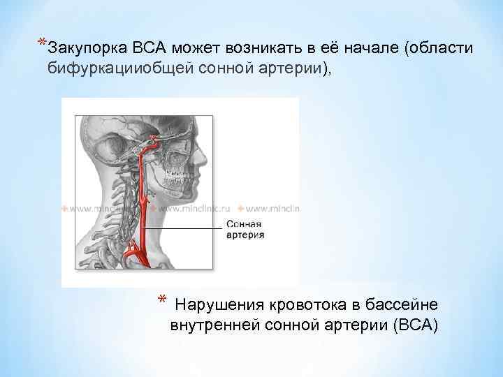 Закупорка сонной артерии фото