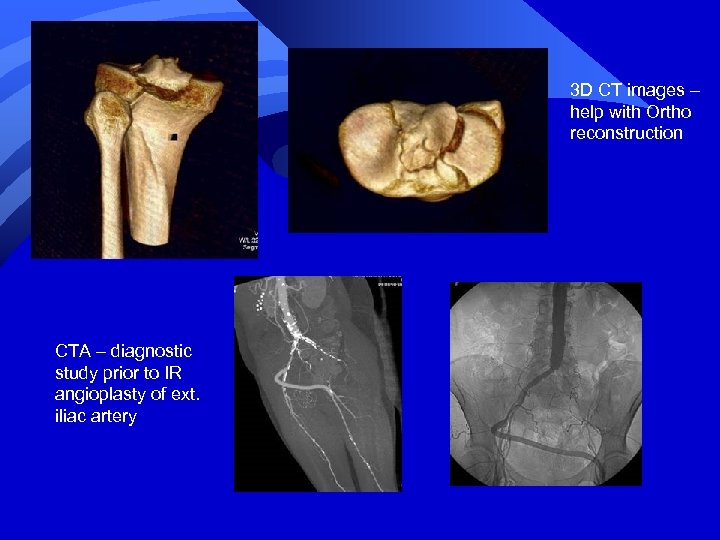 3 D CT images – help with Ortho reconstruction CTA – diagnostic study prior