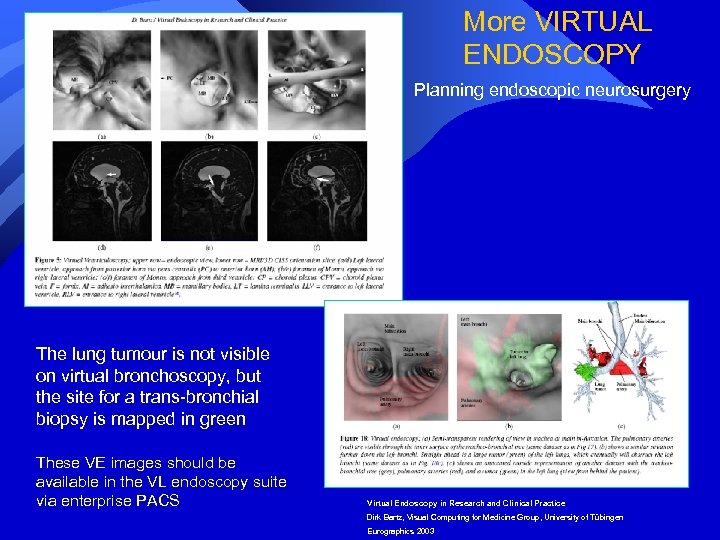 More VIRTUAL ENDOSCOPY Planning endoscopic neurosurgery The lung tumour is not visible on virtual