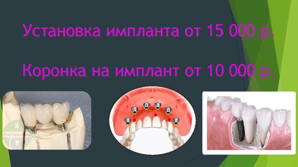 Установка импланта от 15 000 р. Коронка на имплант от 10 000 р. 