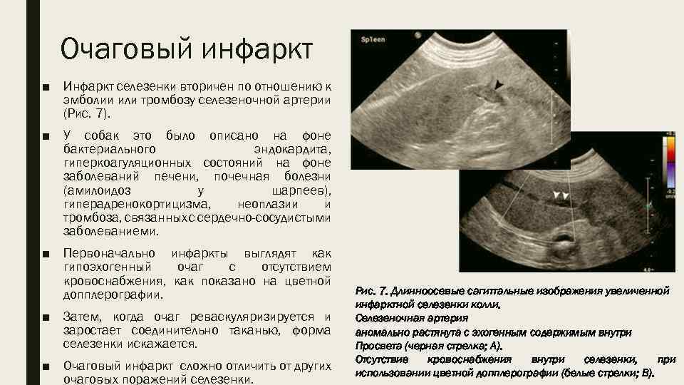 Очаговый инфаркт ■ Инфаркт селезенки вторичен по отношению к эмболии или тромбозу селезеночной артерии
