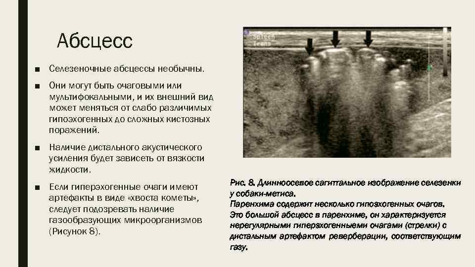 Абсцесс ■ Селезеночные абсцессы необычны. ■ Они могут быть очаговыми или мультифокальными, и их