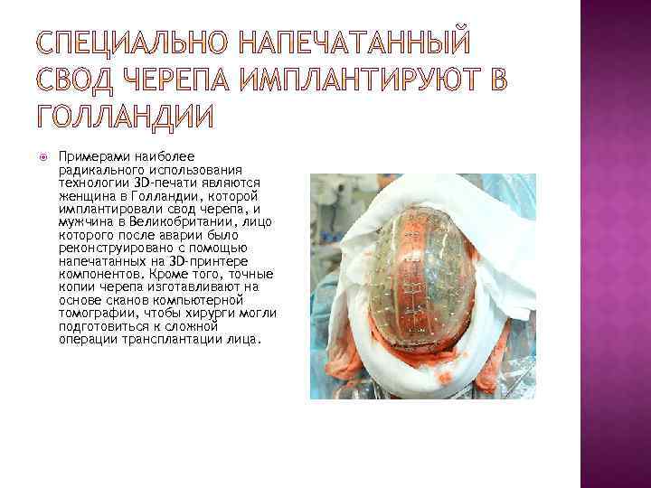  Примерами наиболее радикального использования технологии 3 D-печати являются женщина в Голландии, которой имплантировали