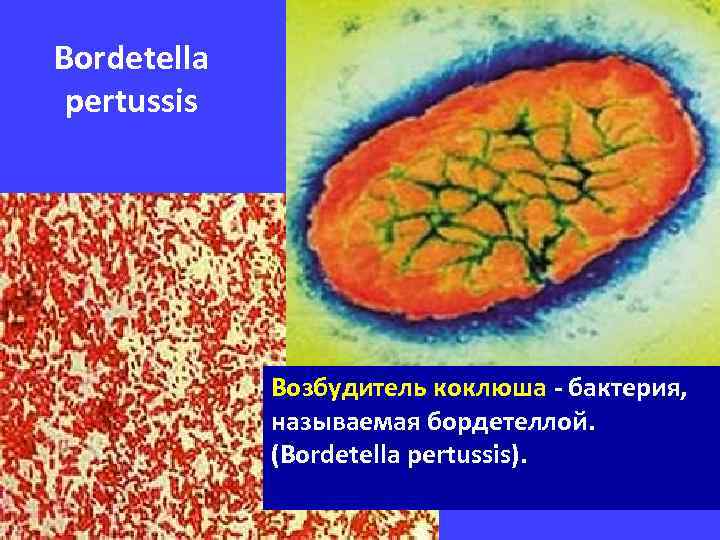 Bordetella pertussis Возбудитель коклюша - бактерия, называемая бордетеллой. (Bordetella pertussis). 