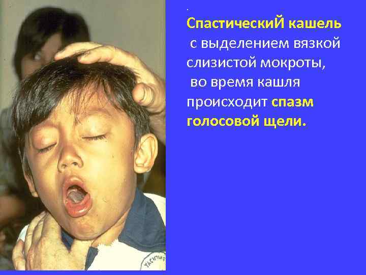 . Спастически. Й кашель с выделением вязкой слизистой мокроты, во время кашля происходит спазм